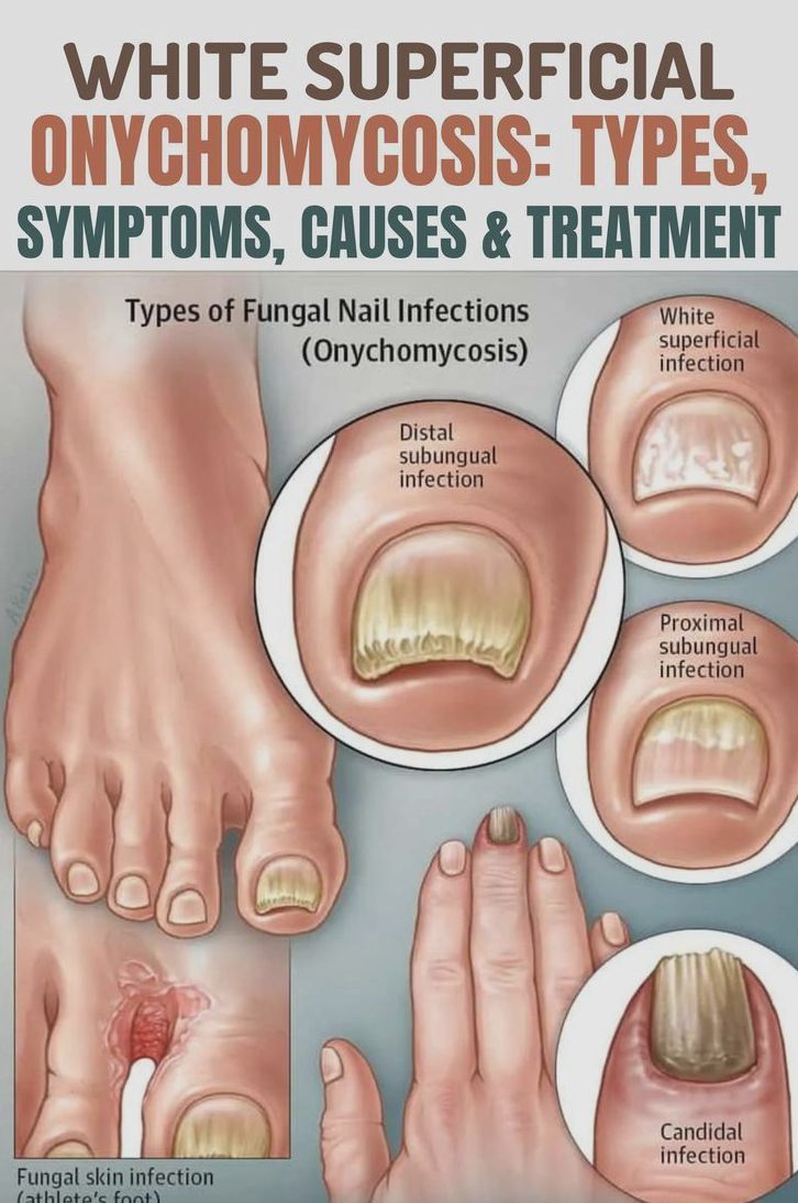 Onychomycosis Image