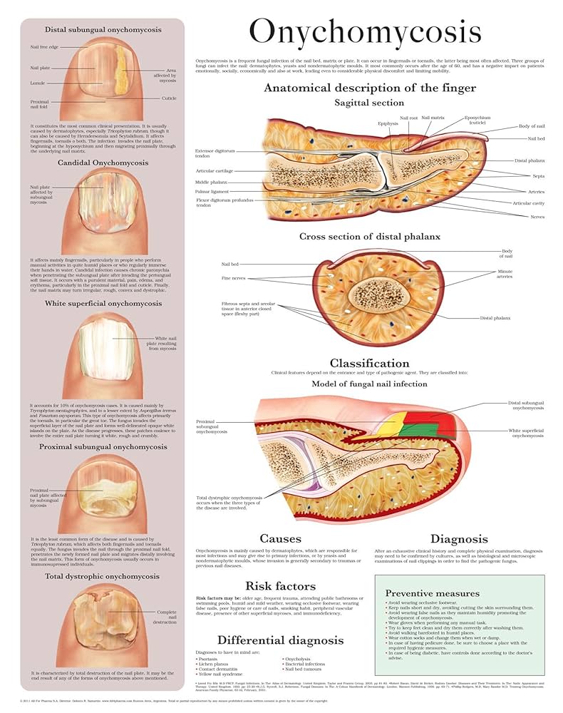 Onychomycosis-web
